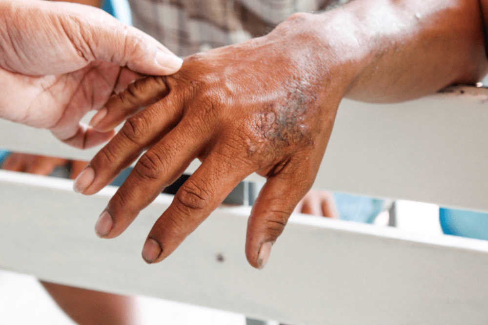 World Leprosy Day Things You Need to Know About The FleshEating