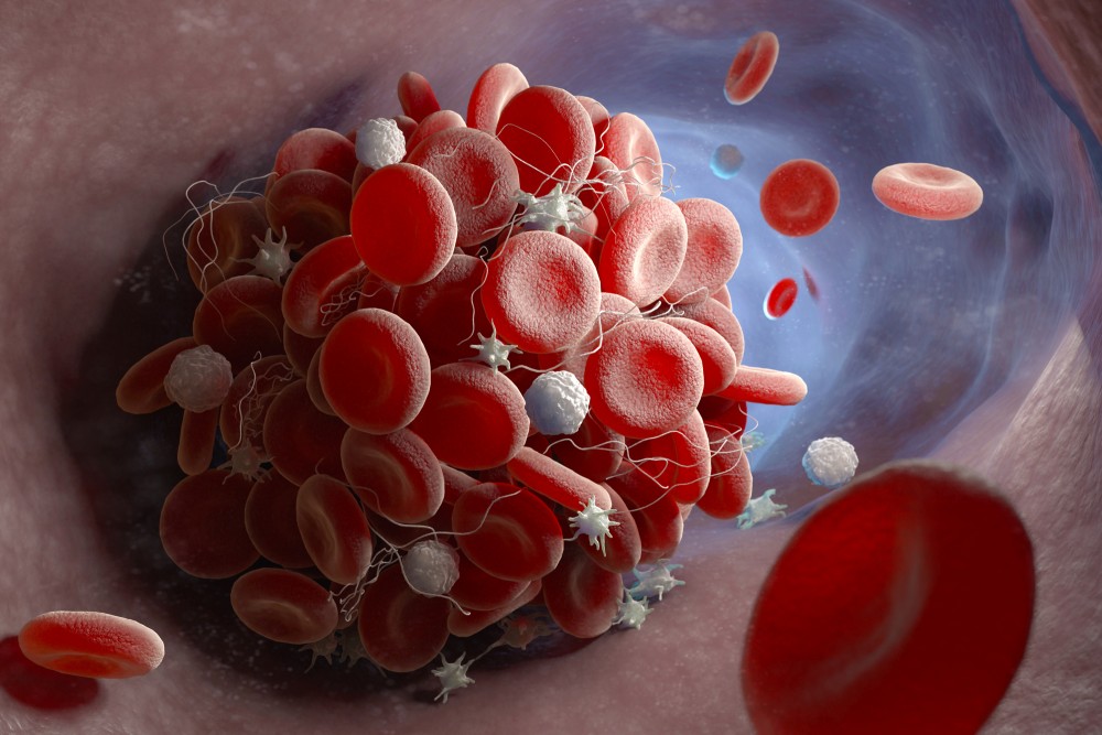 The Anatomy of a Blood Clot: Causes and Risk Factors - Blogs - Makati  Medical Center